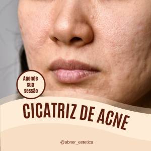 Sofre Com Cicatriz De Acne ? - Estetica E Bem-estar