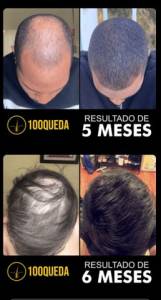 Produtos Cabelo 100quedas Trinoxidil Americano