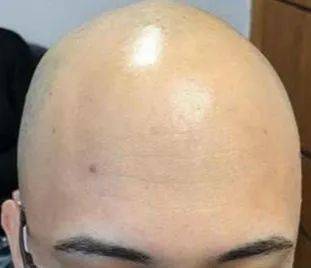 Careca, Calvo, Livre Do Bon Temos A Soluo